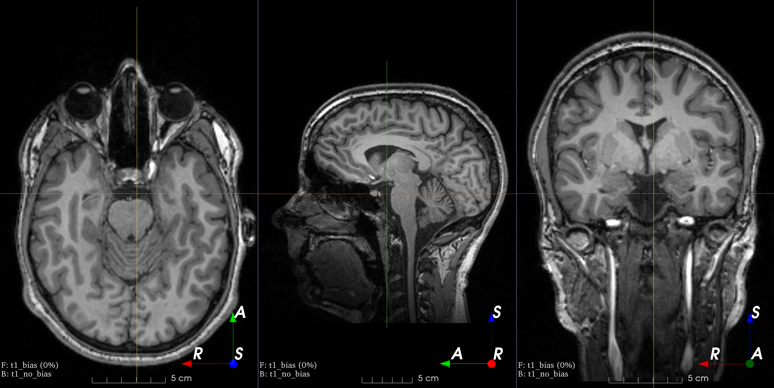 MRI bias field artifact